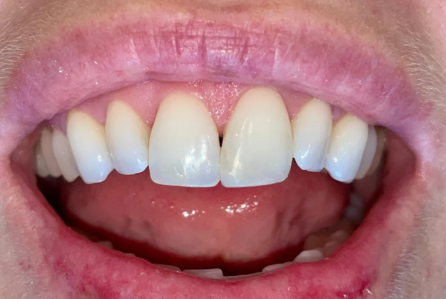 After: the same teeth, the gap closed and the edge restored.