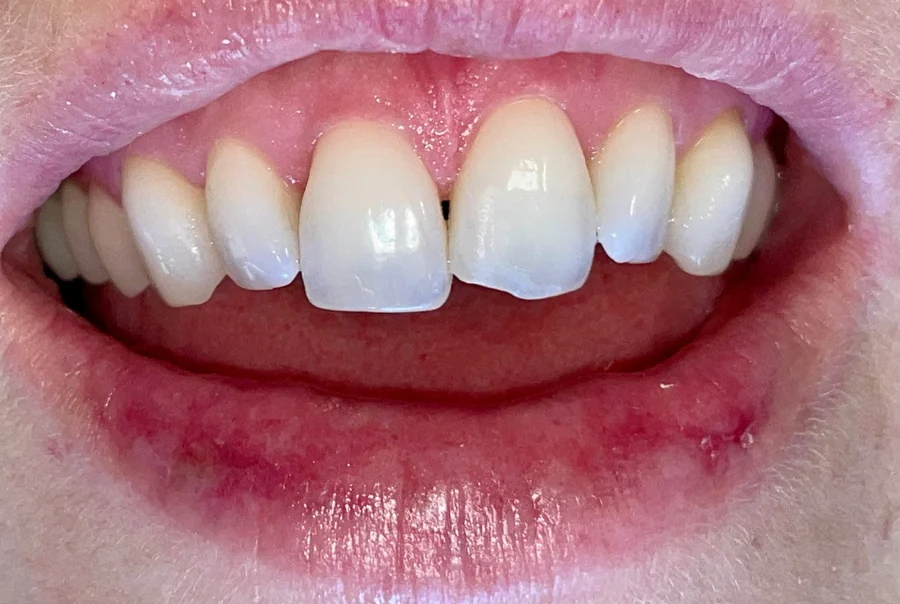 Before: the upper front teeth with a gap and a chipped edge.